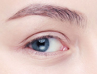 双眼皮手术方法哪种好 双眼皮术后要怎么护理